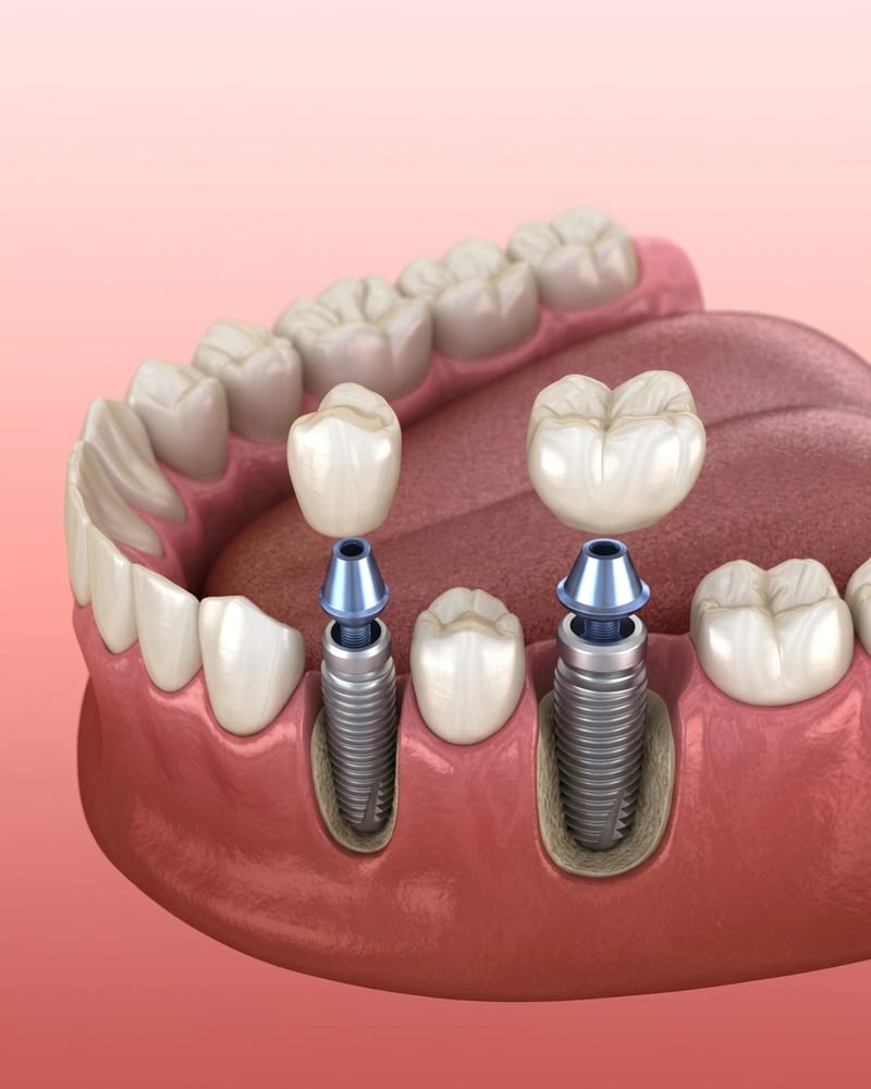 3D illustration of a dental implant being placed between natural teeth at Alpha Dental, Sutera Utama