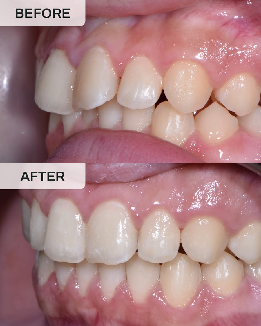 Before and after Invisalign treatment at Alpha Dental, Sutera Utama, case 1