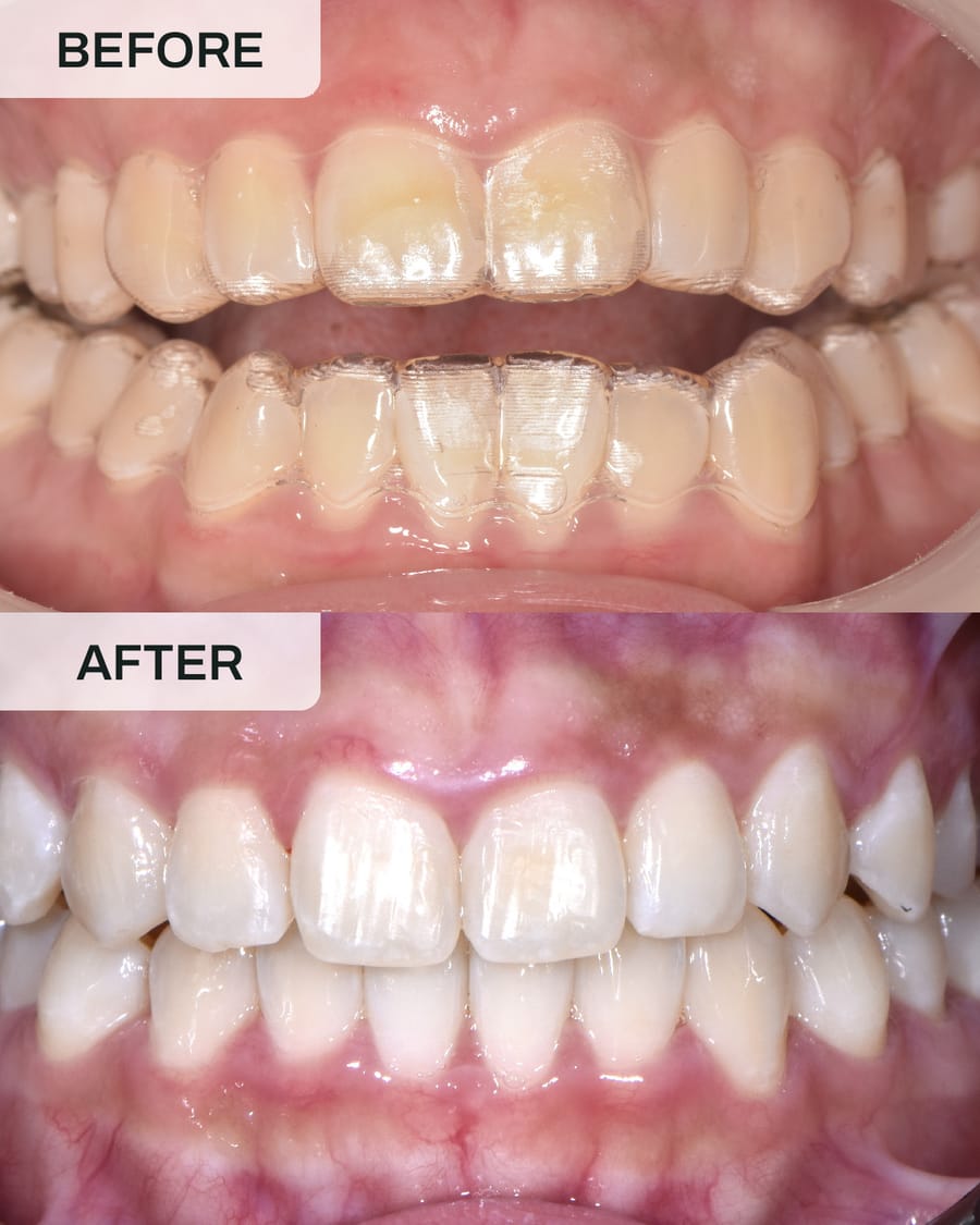 Before and after Invisalign treatment at Alpha Dental, Sutera Utama, case 2