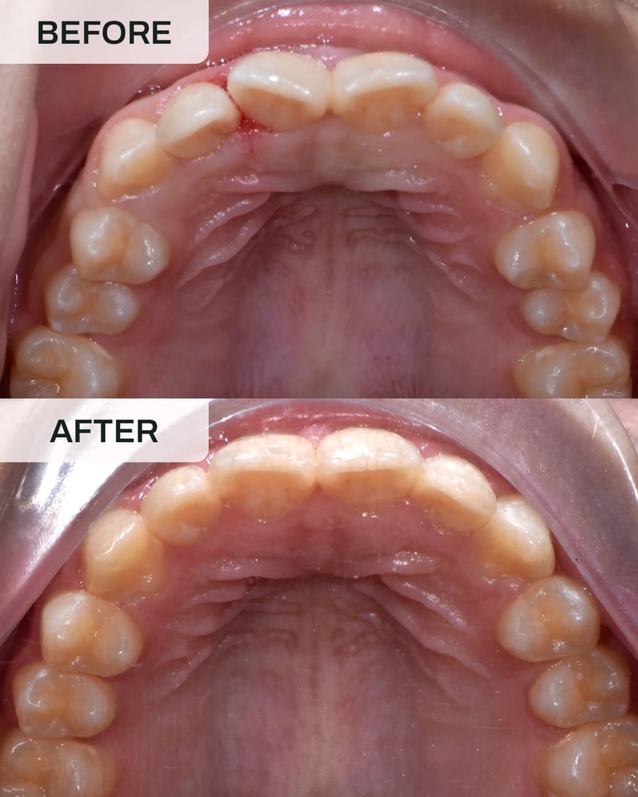 Before and after Invisalign treatment at Alpha Dental, Sutera Utama, case 3