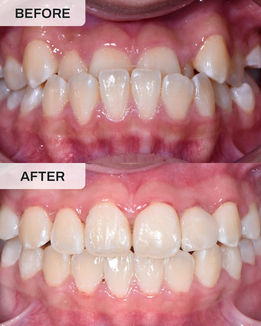 Before and after orthodontic treatment at Alpha Dental, Sutera Utama, case 1