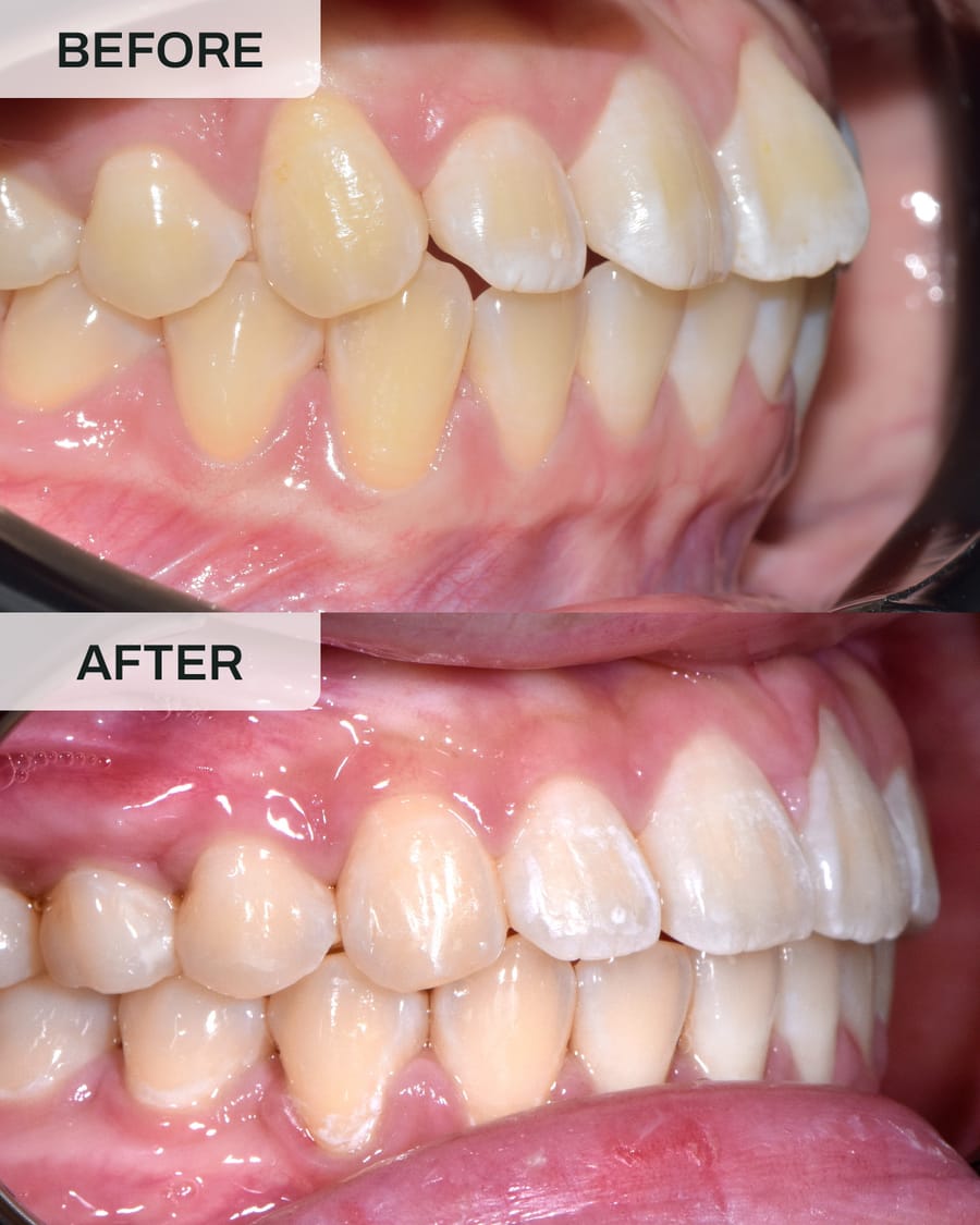 Before and after orthodontic treatment at Alpha Dental, Sutera Utama, case 2
