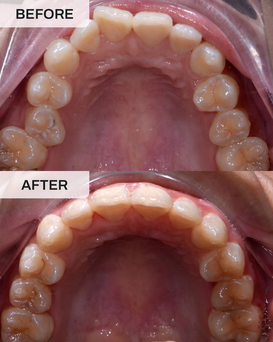 Before and after orthodontic treatment at Alpha Dental, Sutera Utama, case 4