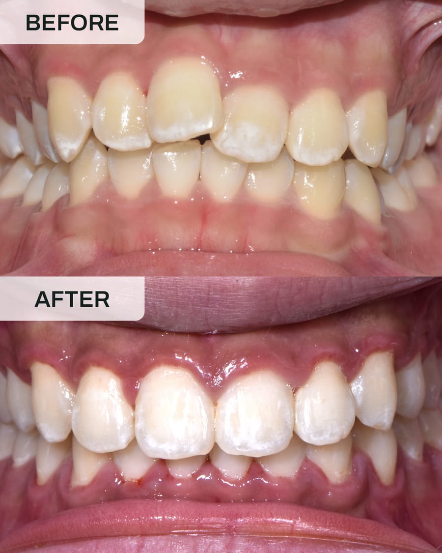 Before and after orthodontic treatment at Alpha Dental, Sutera Utama, case 5