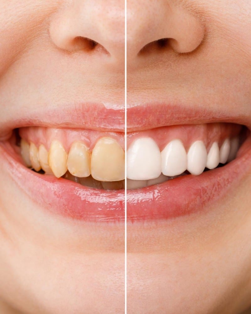 Teeth Whitening