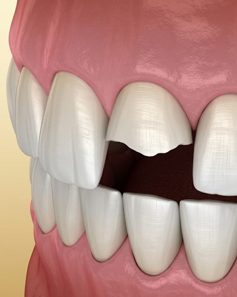 Broken Tooth Repair