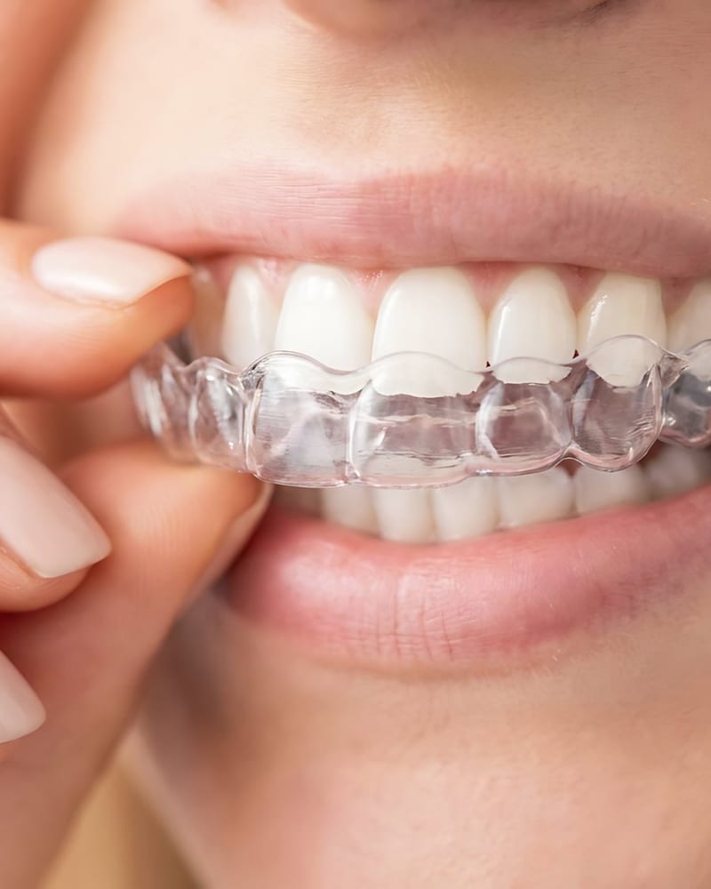 Clear Aligners