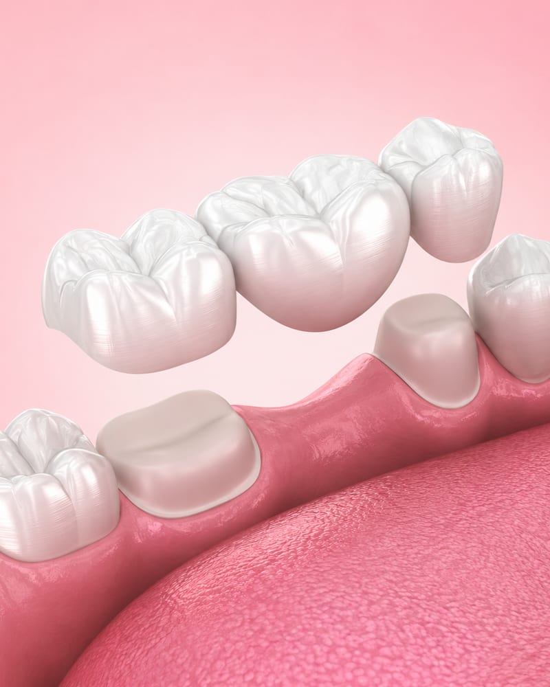 3D illustration of a natural-looking dental crown being placed onto a prepared tooth at Alpha Dental, Sutera Utama