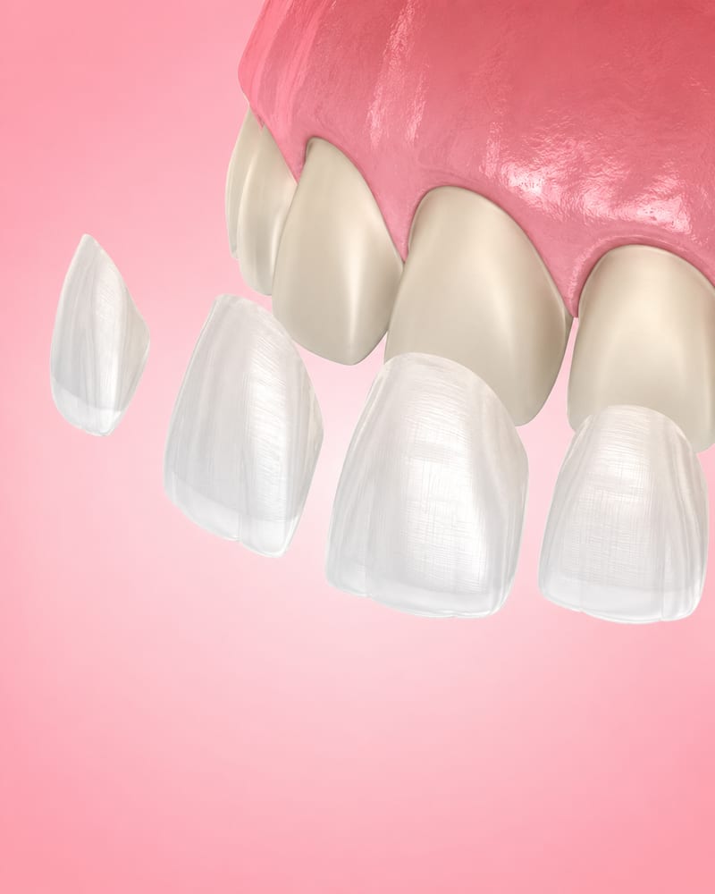 Veneers