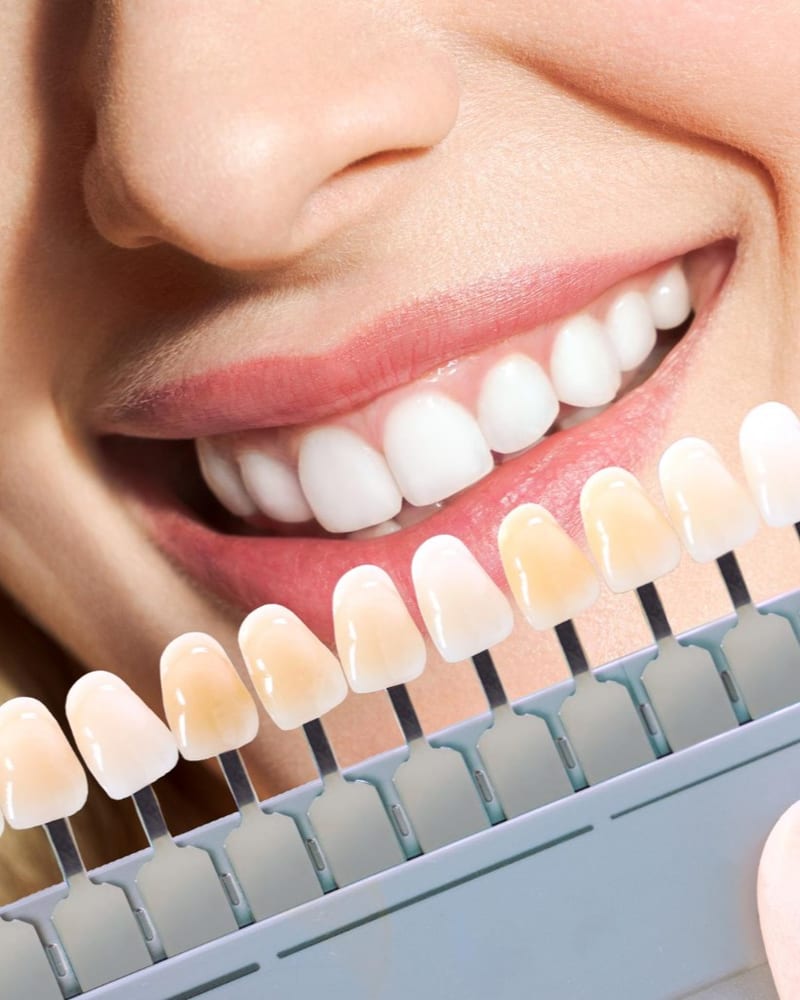 Close-up of a dentist checking a patient's tooth shade against her smile at Alpha Dental, Sutera Utama