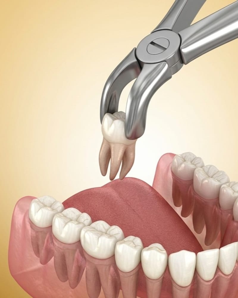 Wisdom Tooth Removal