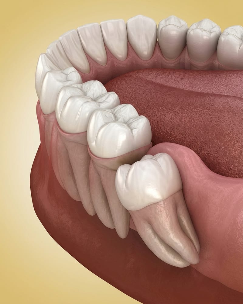 Dentist examining a patient's wisdom teeth with a mouth mirror at Alpha Dental, Sutera Utama